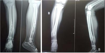 Response to Zoledronic Acid Infusion in Children With Fibrous Dysplasia